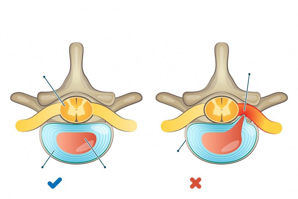 intervertebral discs one healthy, the other with a hernia