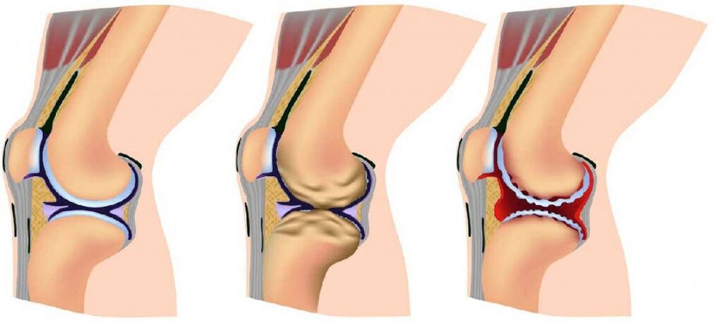 Healthy articulation and hit by osteoarthritis