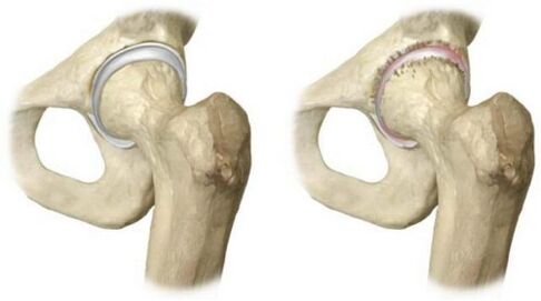 healthy hip joint and affected by arthrosis